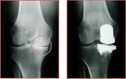 best Partial Knee Replacement surgeon in Mumbai