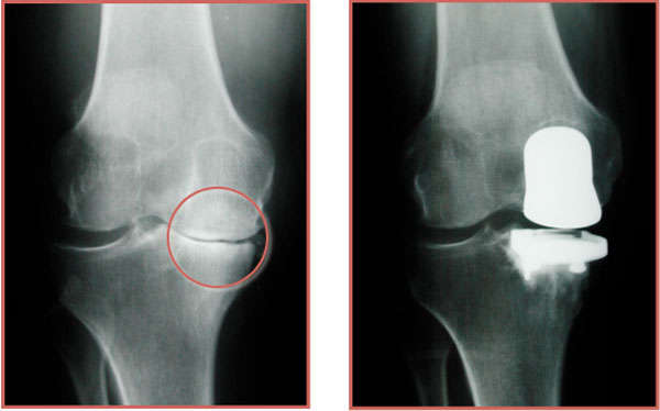 best Partial Knee Replacement surgeon in Mumbai