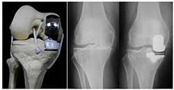 best Partial Knee Replacement surgeon in Mumbai