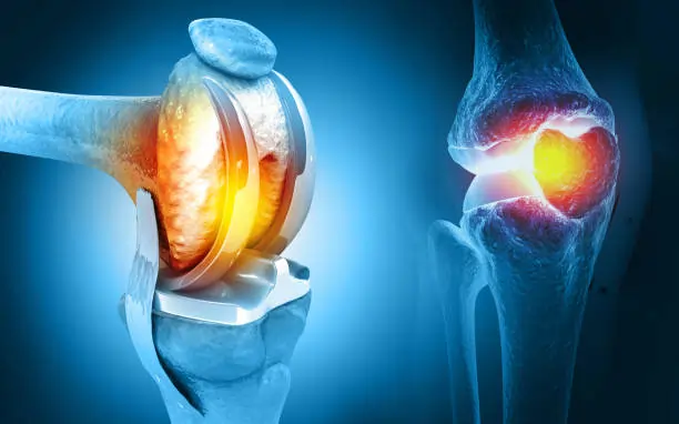Knee Replacement Surgery in Jaipur