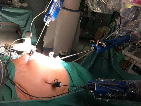 Robotic Uterus Removal Surgery in Mohali