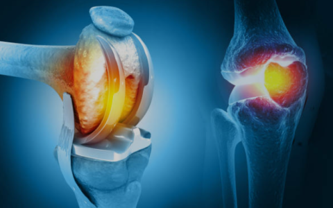 Knee replacement surgery in Delhi