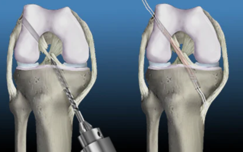 ACL surgery in Goa