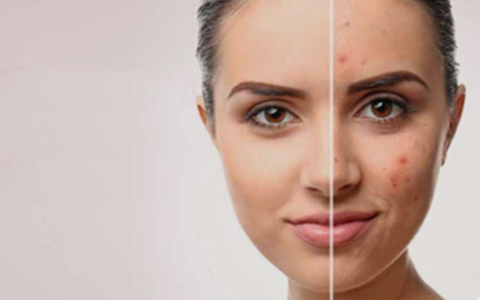 Acne scar treatment chandigarh