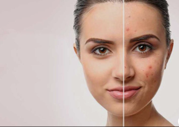 Acne scar treatment chandigarh